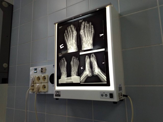 Врачи Иркутской областной клинической больницы взялись за лечение деформации стопы